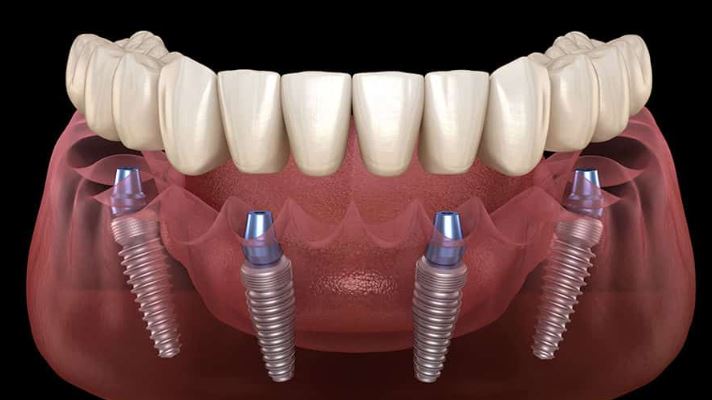 Who is an Ideal Candidate for All-on-4 dental Implants?