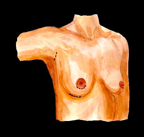 Cover image for Breast Augmentation Recovery Guide