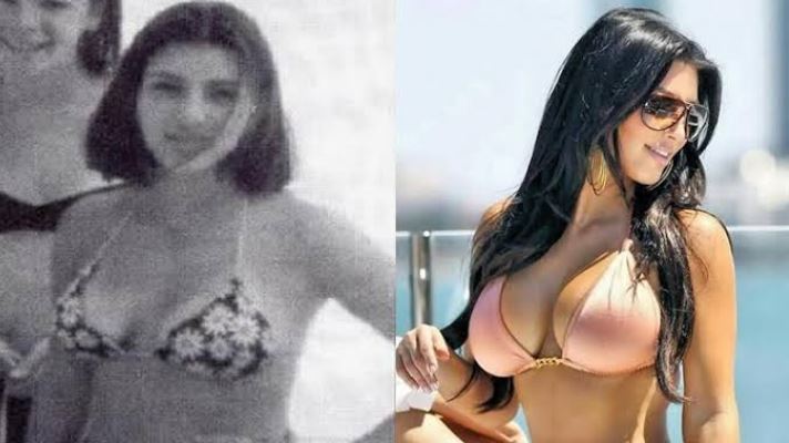 All you need to know about Breast Lift Surgery in 2023