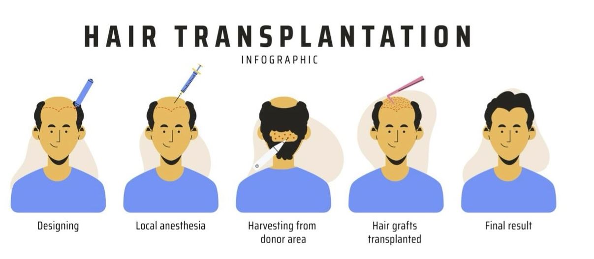 Hair Transplant Shock Loss: Strategies for Coping and Recovery