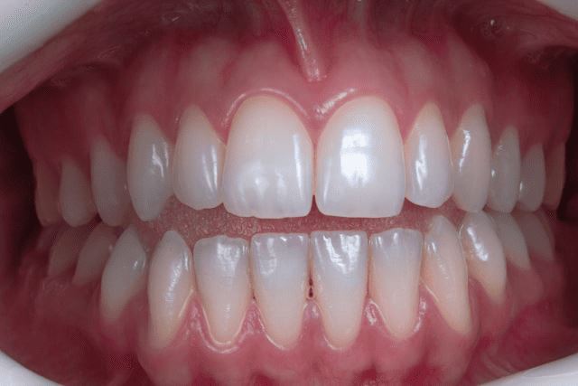 Titelbild für How to Prevent a Dental Implant Infection: Dentist Approved Tips