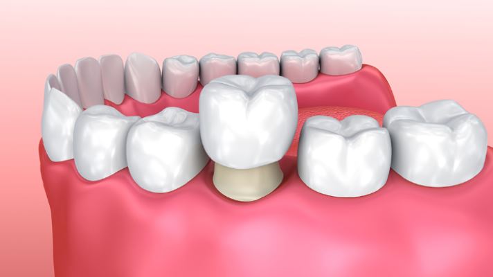 6 Surprising Facts About Dental Crowns in 2023