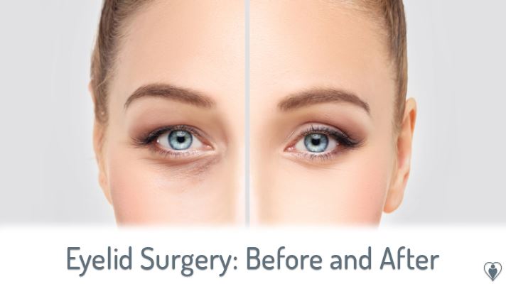 Eyelid Surgery: Before and After