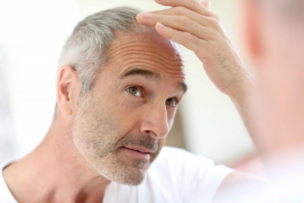 What is Male Pattern Baldness? | Hair Loss Treatment