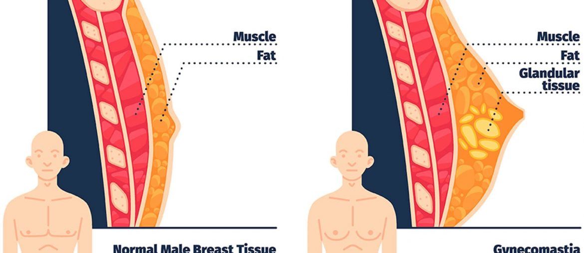 Cover image for 5 Things You Should Know About Gynecomastia Surgery