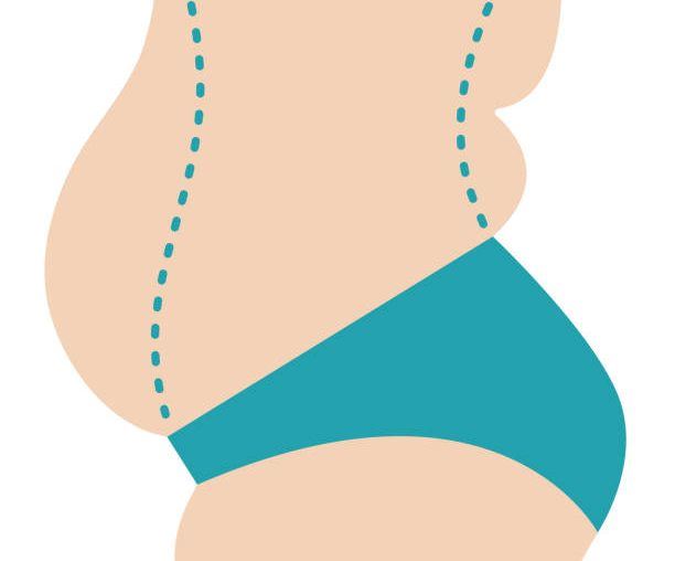 5 Things You Should Know About Slim Lipo