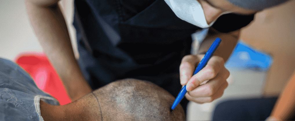 How To Avoid The Dangers of Overharvesting Hair Transplants