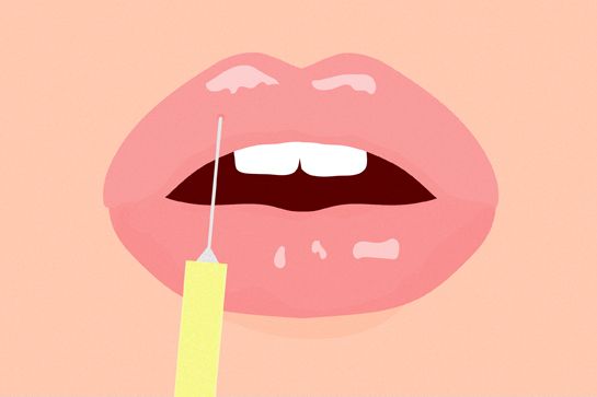 Cover image for Lip Implants - Six Things You Should Know About Lip Augmentation