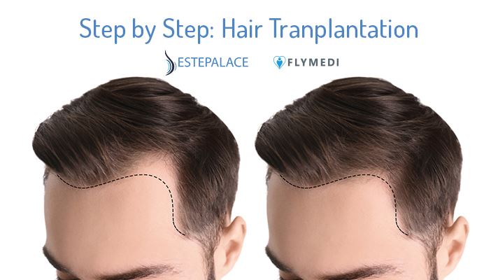 Step by Step: Hair Transplantation