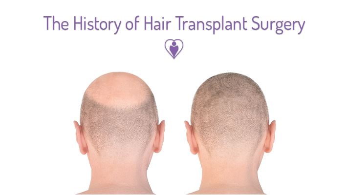 The History of Hair Transplant Surgery