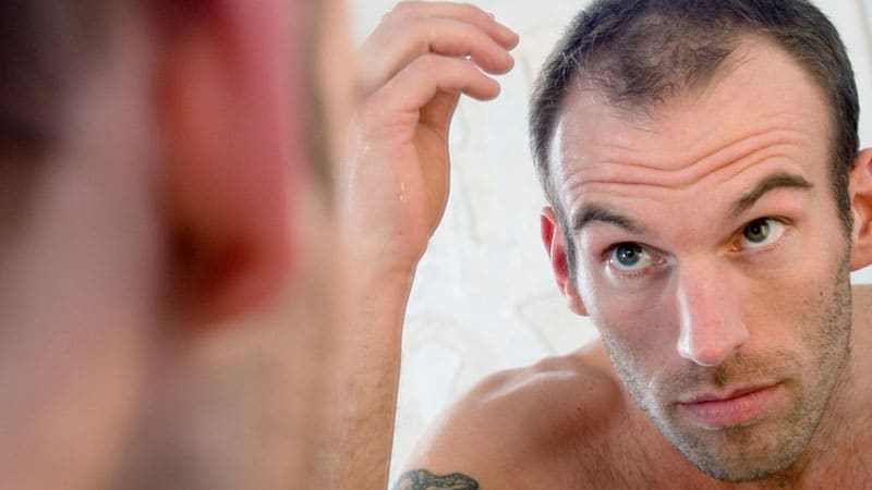 FUE Hair Transplant – The top 8 things you need to know