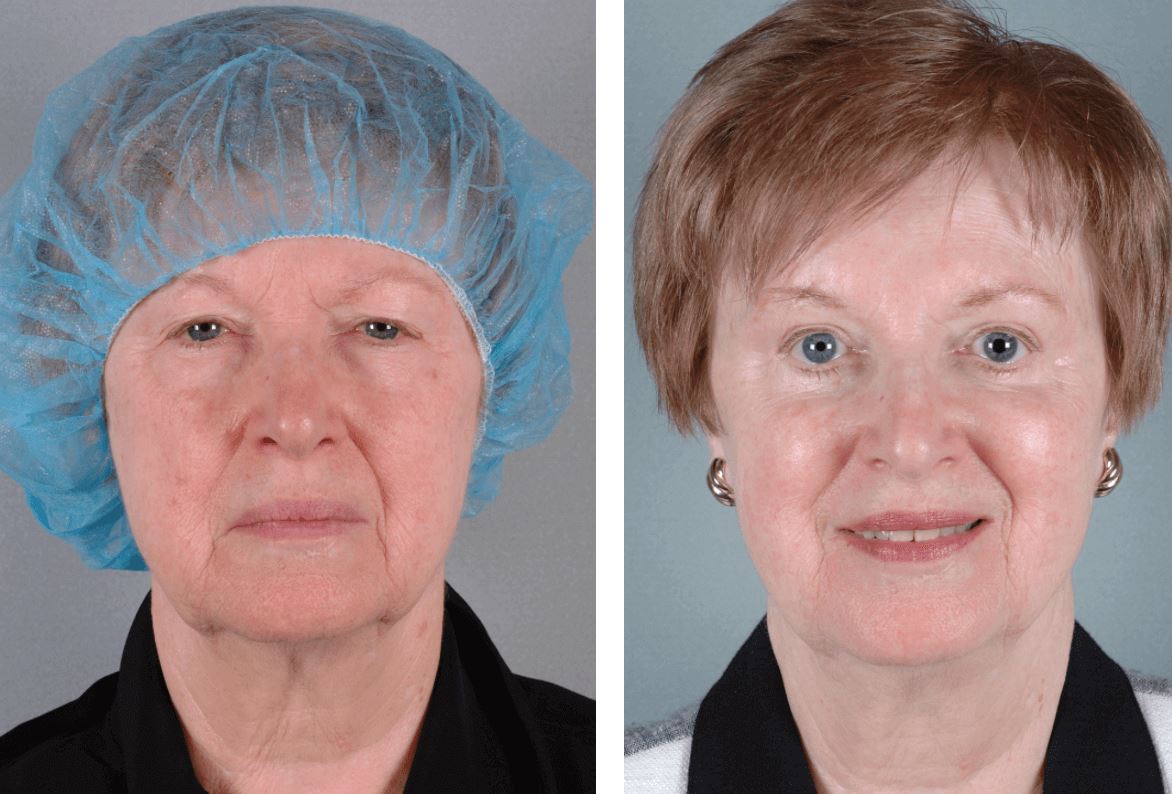 Is It Safe to Have Blepharoplasty Surgery?