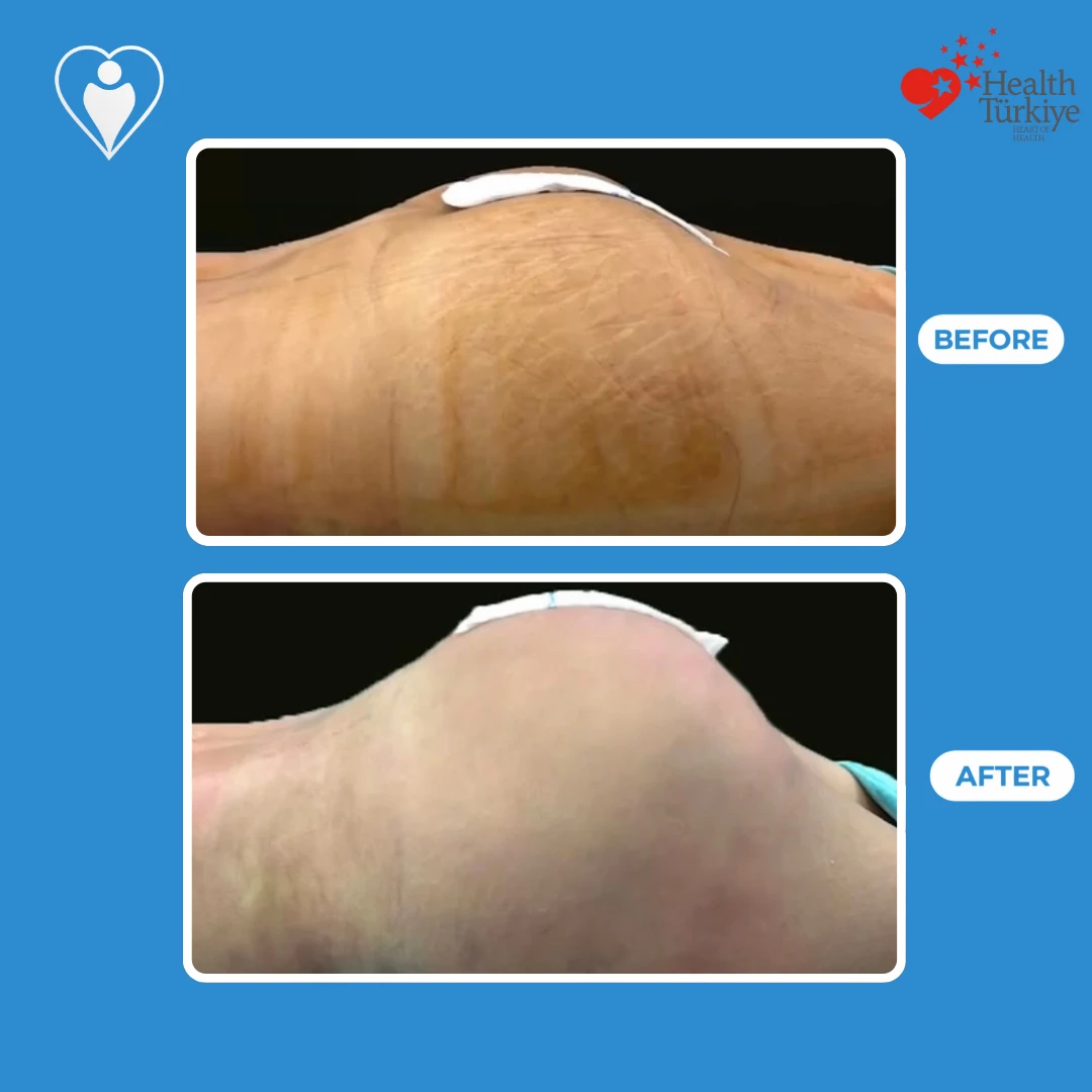 Breast surgery before and after: side view of a breast on the operating table with the nipple taped, before and with a rounder, more projected contour after, patient of Dr. Anvar Ahmedov, Flymedi.