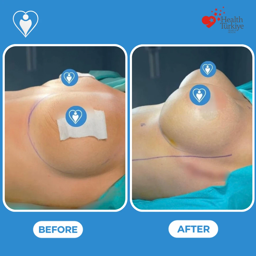Breast surgery in Istanbul, before and after: side view of a woman's breast on the operating table with surgical markings before and a fuller, rounder shape after, patient of Dr. Anvar Ahmedov, Flymedi.