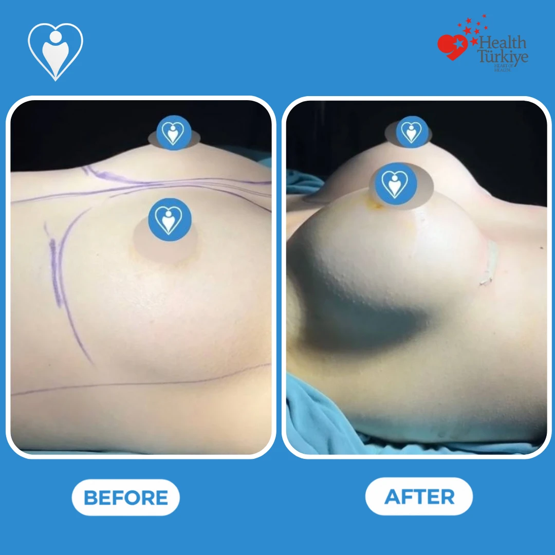 Breast surgery in Turkey, before and after: side view of a small breast with surgical markings before and a fuller, higher shape after, on the operating table, patient of Dr. Anvar Ahmedov, Flymedi.