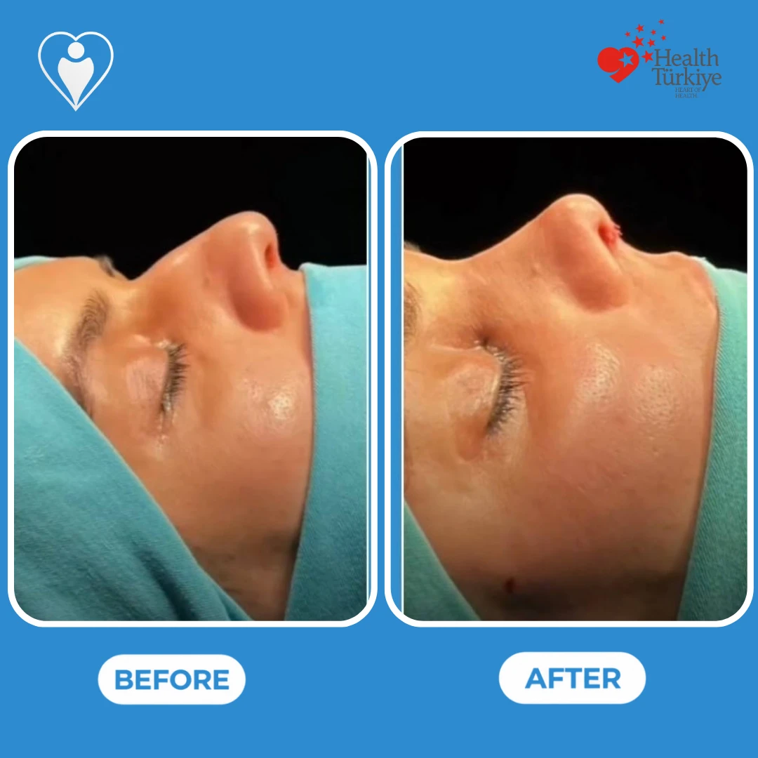 Nose surgery before and after: side profile of a woman's nose on the operating table before and just after surgery, with a straighter bridge and a lifted tip, patient of Dr. Anvar Ahmedov, Flymedi.