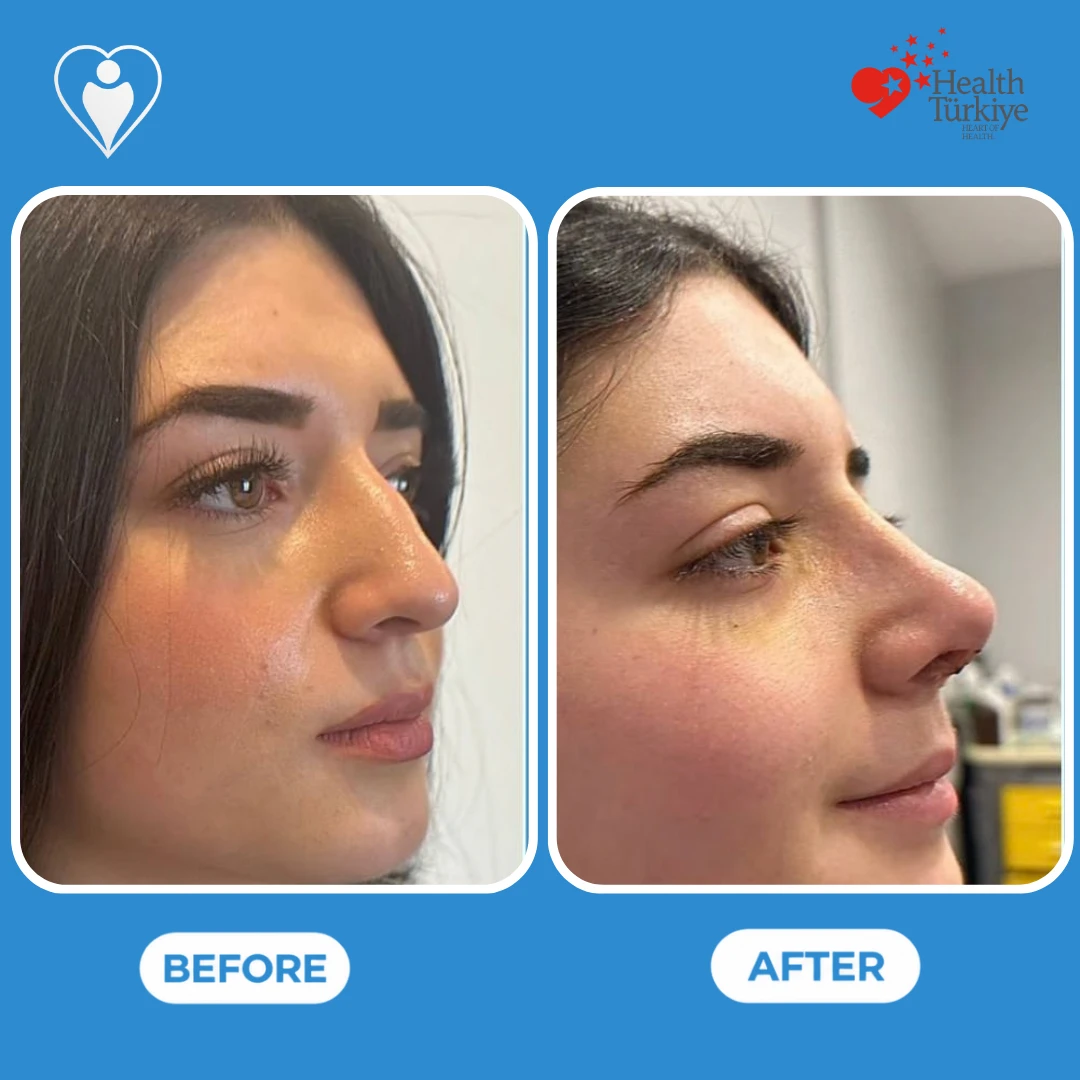 Nose surgery in Istanbul, before and after: angled view of a woman's nose with a hump on the bridge before and a straighter bridge after, with light bruising under the eyes, patient of Dr. Anvar Ahmedov, Flymedi.