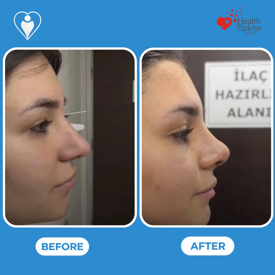 Nose surgery in Turkey, before and after: side profile of a woman's nose with a hump and a drooping tip before and a straighter, smaller nose after, patient of Dr. Anvar Ahmedov, Flymedi.