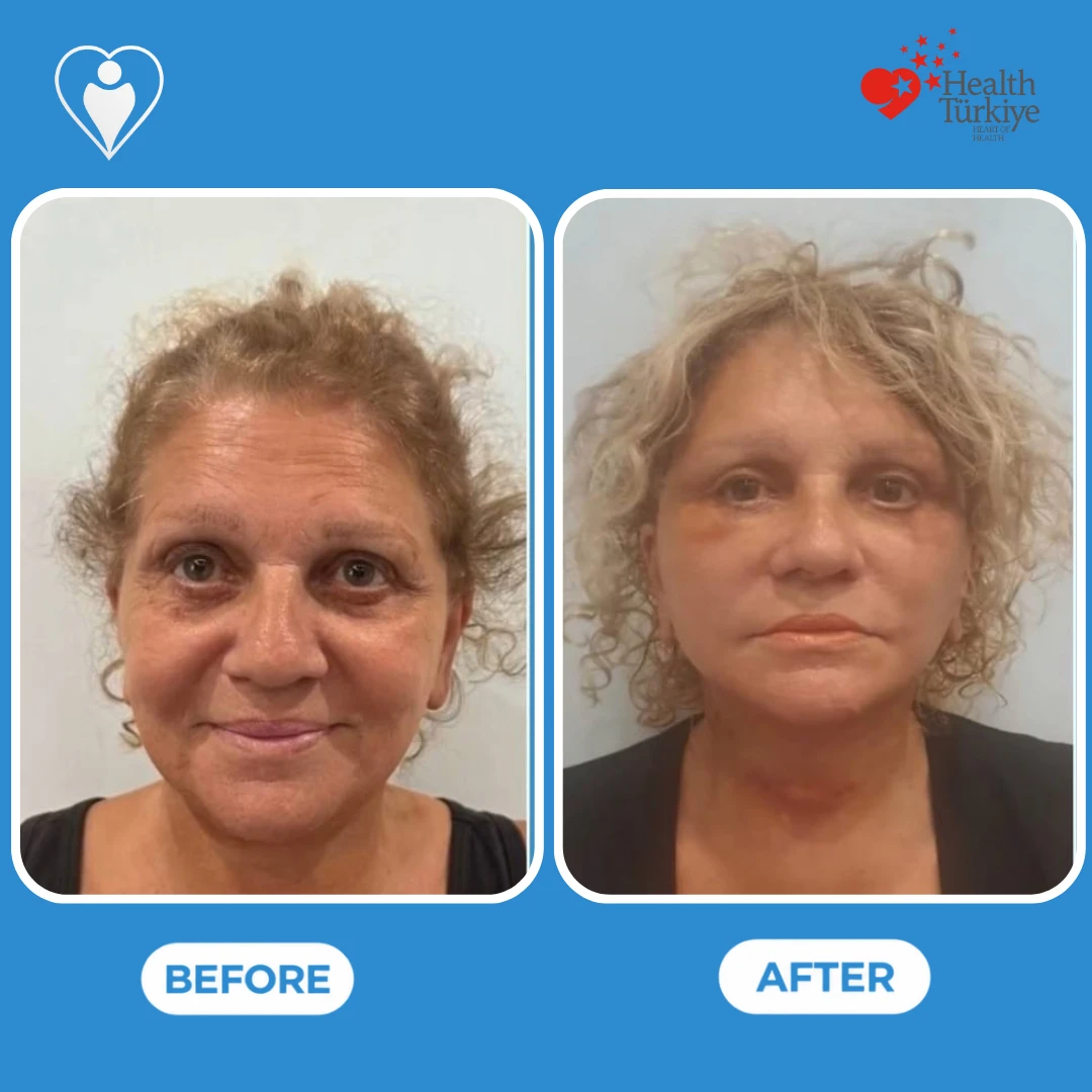 Facial surgery before and after: front view of a woman's face with deep wrinkles and loose skin before and a smoother, tighter face soon after surgery, patient of Dr. Anvar Ahmedov, Flymedi.