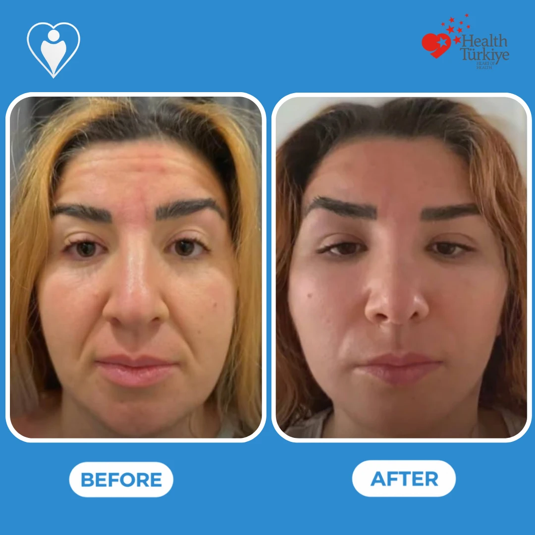 Facial plastic surgery in Istanbul, before and after: front view of a woman's face with forehead lines before and a smoother forehead and softer lower face after, patient of Dr. Anvar Ahmedov, Flymedi.