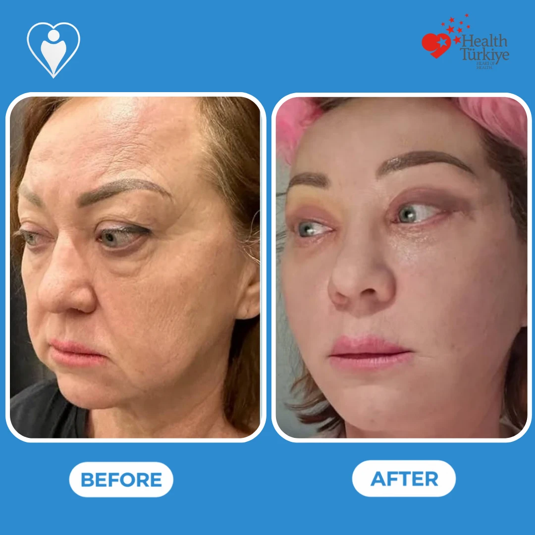 Facial surgery in Turkey, before and after: angled view of a woman's face with heavy eyelids and a sagging jawline before and a tighter face soon after surgery, with bruising around the eyes, patient of Dr. Anvar Ahmedov, Flymedi.
