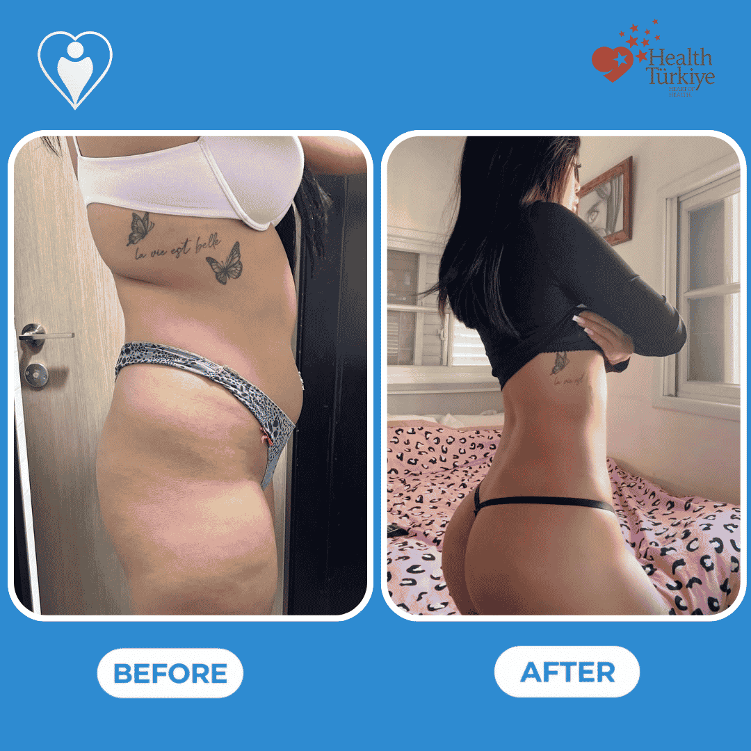 Before and after photos of a body contouring procedure, side view of the torso.