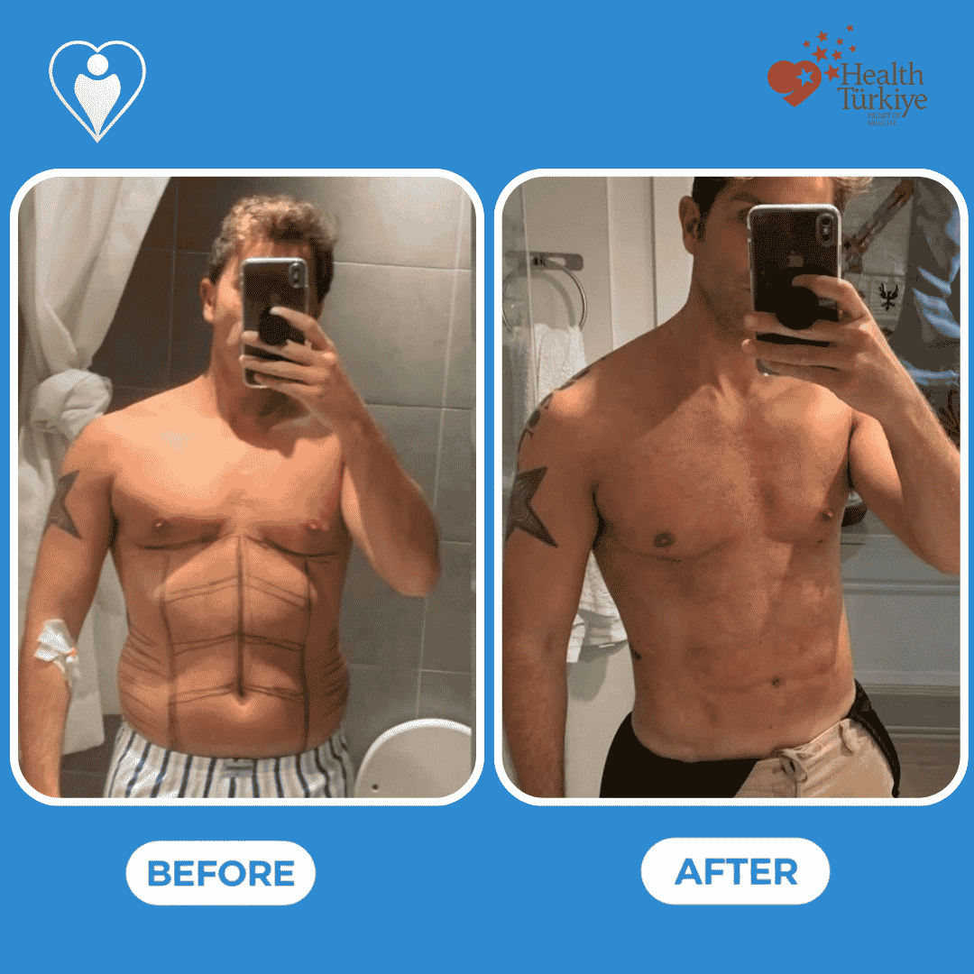 Before and after photos of an arm lift procedure, close view of the upper arm.
