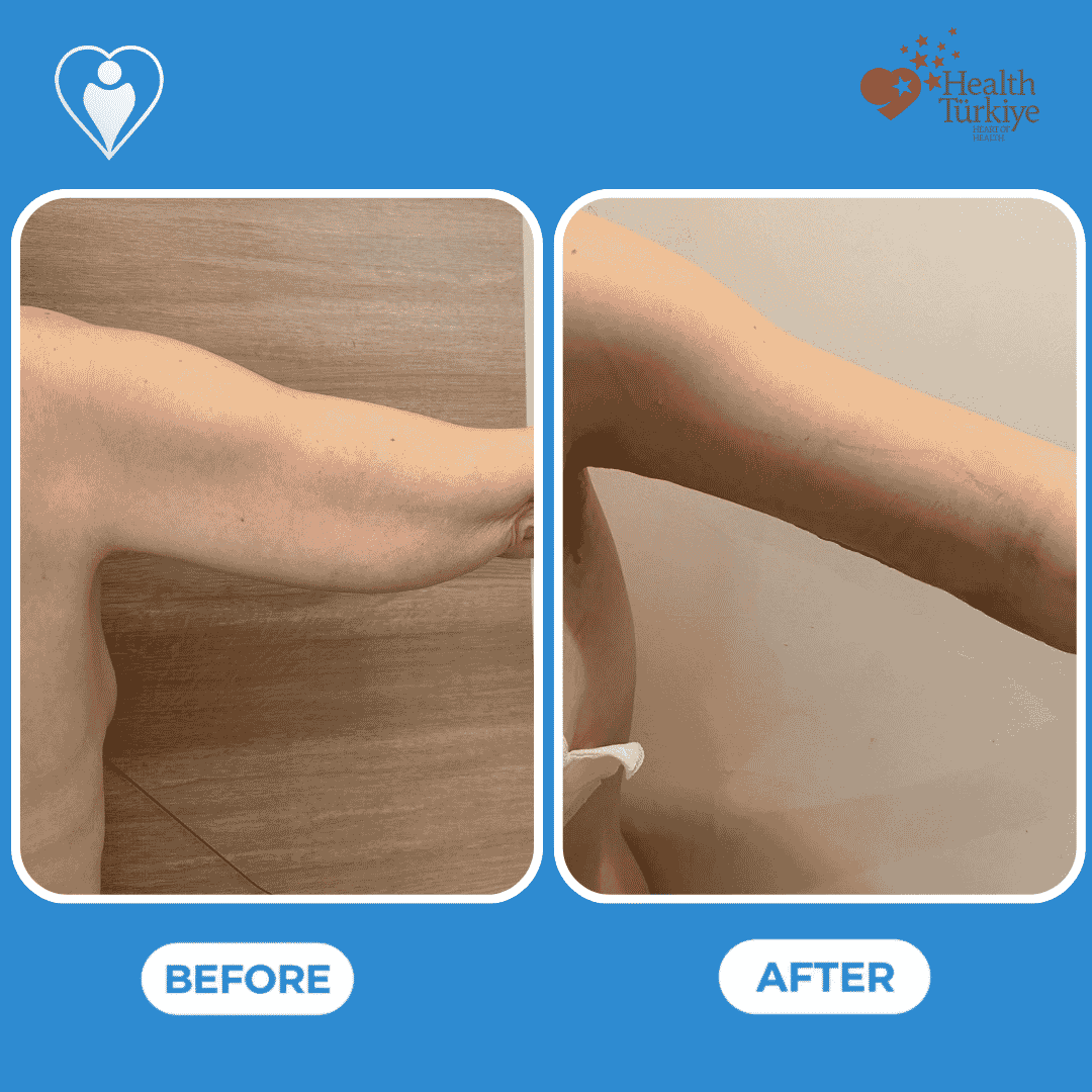 Before and after photos of a body contouring procedure, back view of the hips and legs.