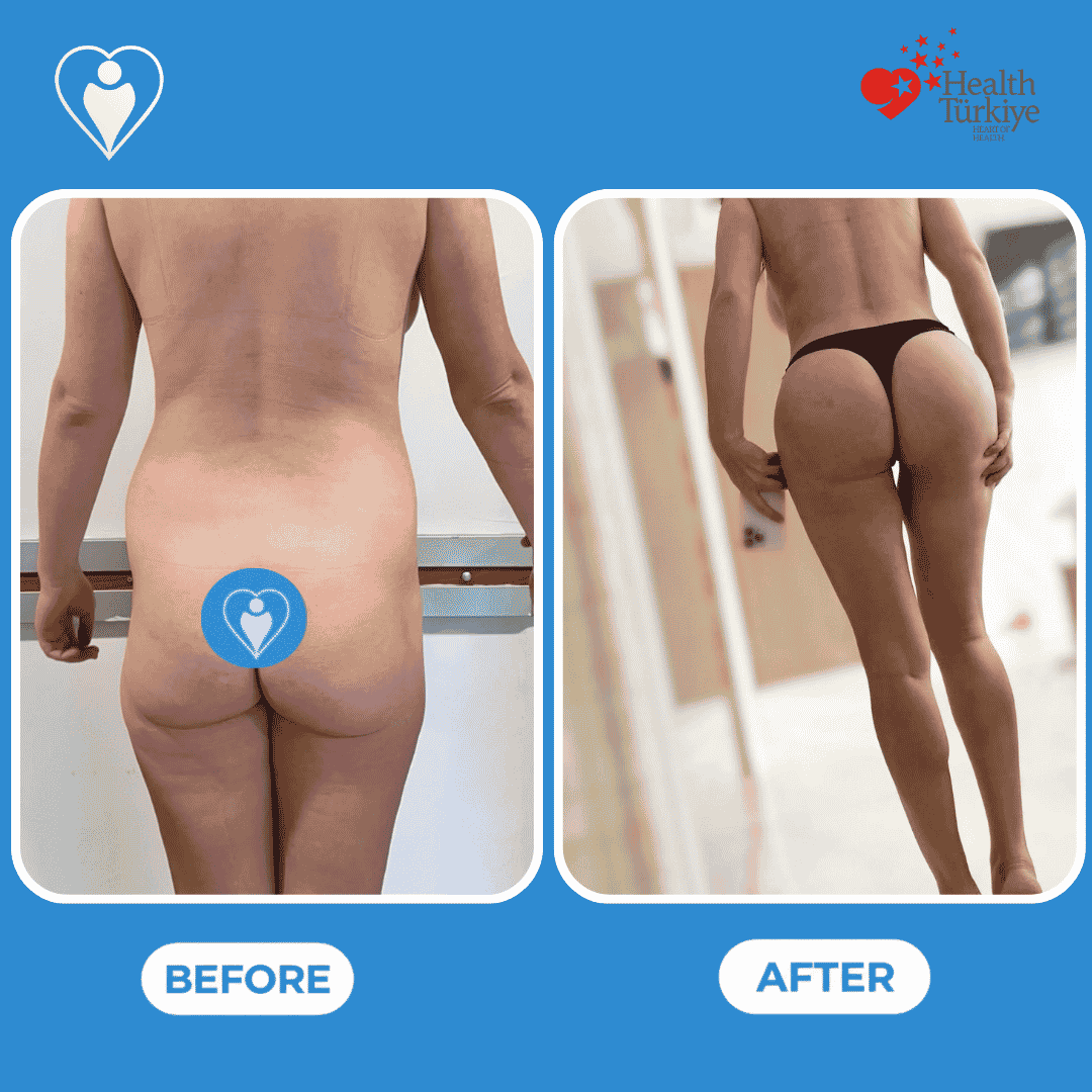 Before and after photos of a breast augmentation procedure, front view of the chest.