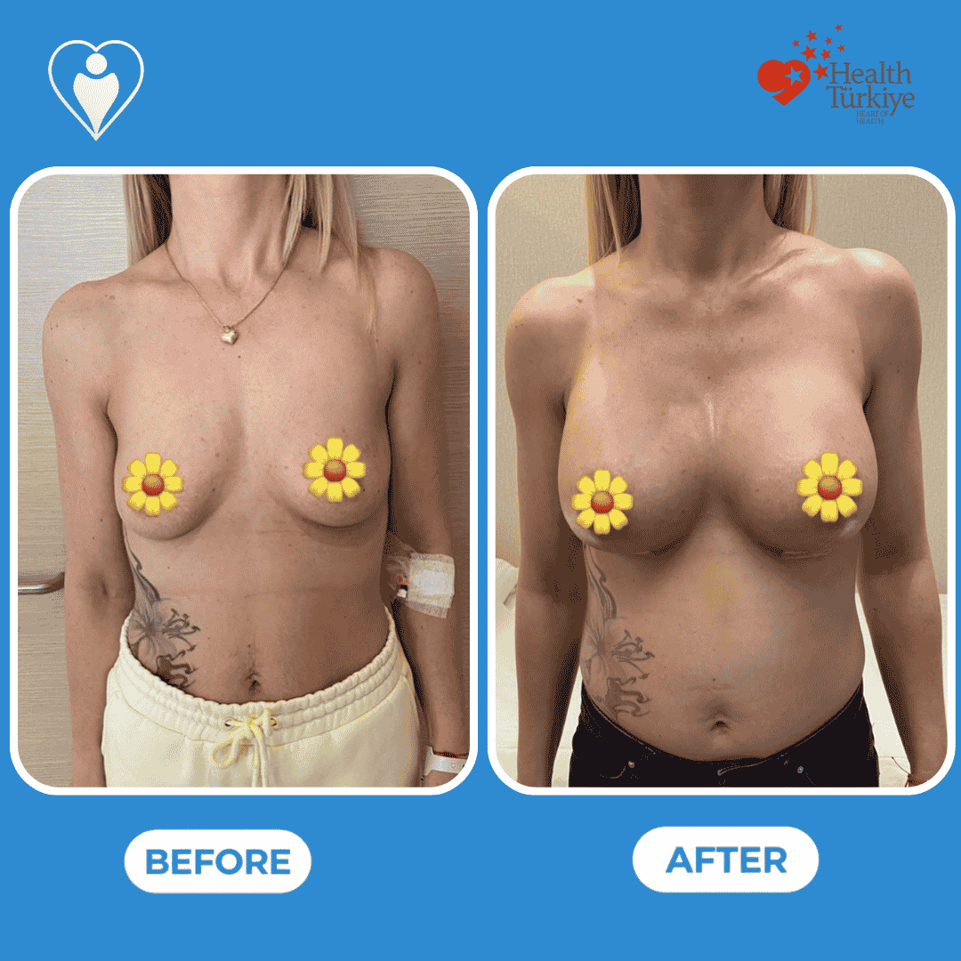 Before and after photos of a body contouring procedure, full body front and back view.
