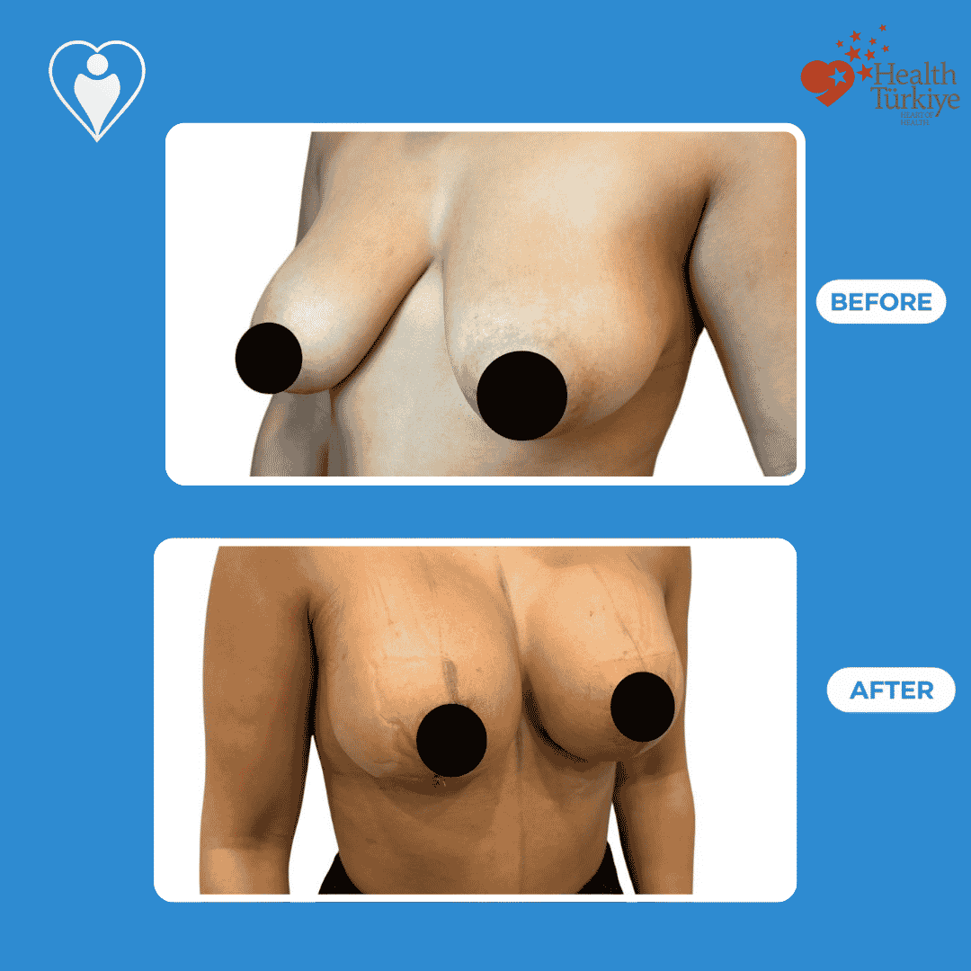 Before and after photos of a breast lift procedure, front view of the chest.