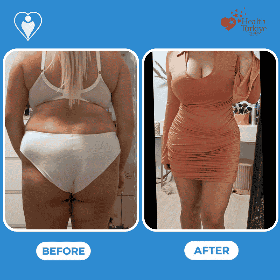 Before and after photos of a body contouring procedure, front view of the torso.