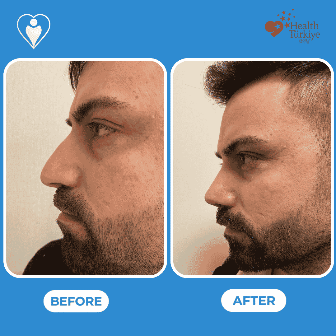 Before and after photos of an arm lift procedure, close view of the upper arm.