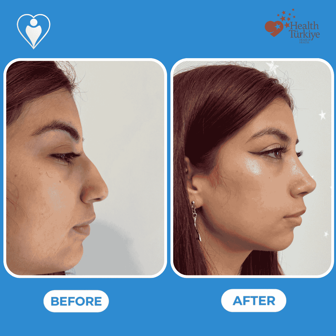 Before and after photos of a rhinoplasty procedure, side profile view of the nose.