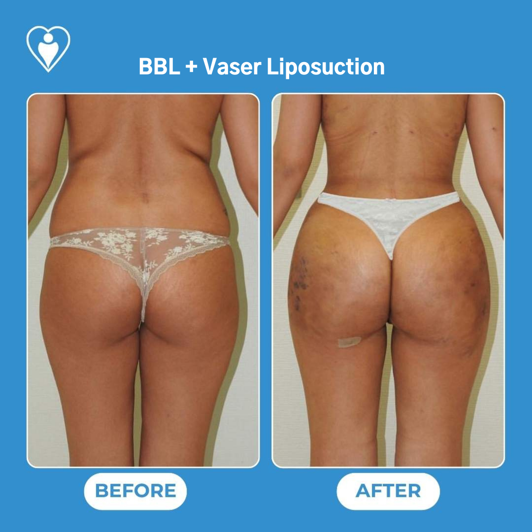 Brazilian Butt Lift et liposuccion Vaser avant et après : le dos et les hanches d'une femme avant, et avec un contour plus plein après, patiente du Dr Ergin Er, Flymedi.