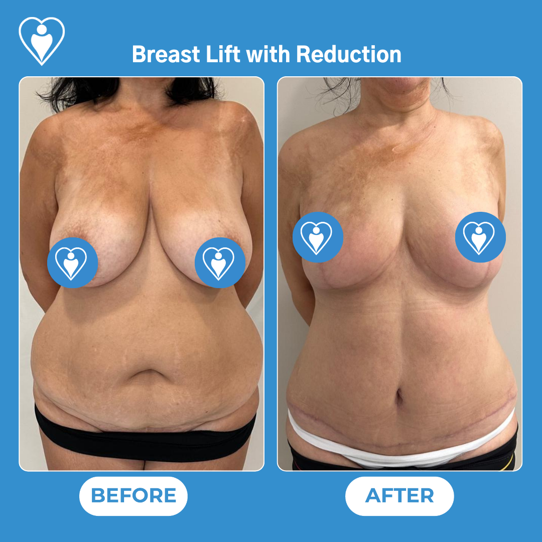 Réduction et lifting mammaire avant et après : la vue de face d'une femme avant, et avec un contour de poitrine relevé et réduit après, patiente du Dr Ergin Er, Flymedi.