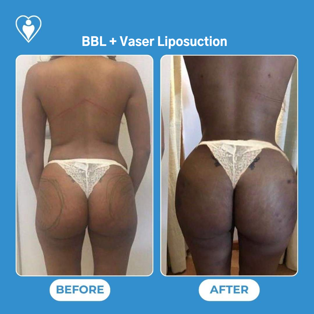 Brazilian Butt Lift avant et après : des marquages chirurgicaux sur les hanches avant, et une silhouette plus pleine après, patiente du Dr Ergin Er, Flymedi.