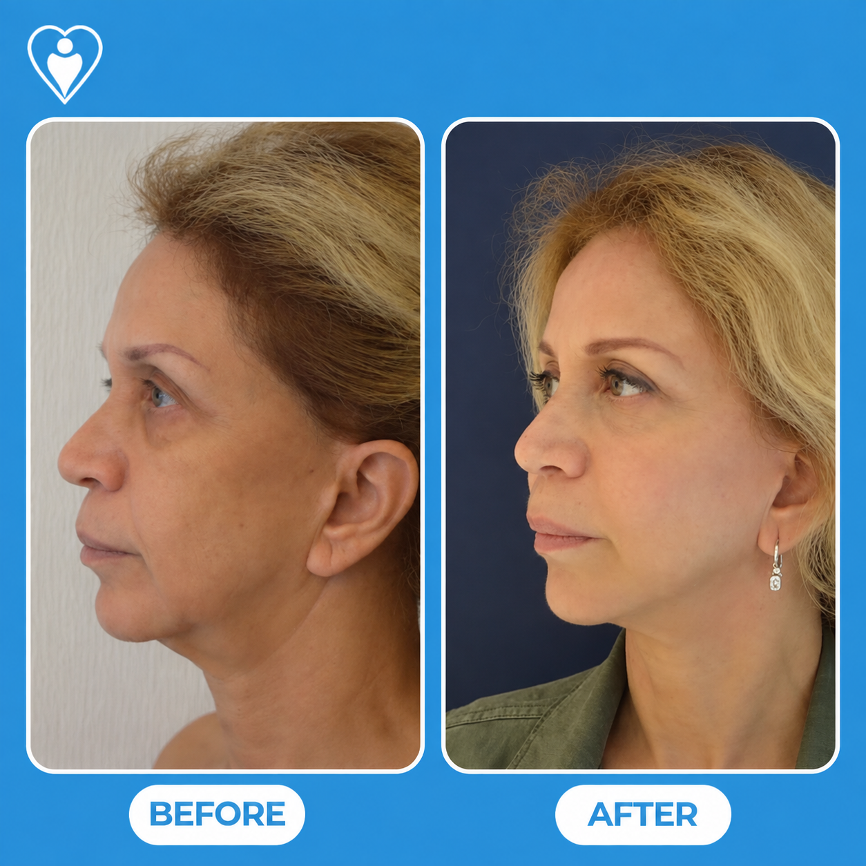 Facelift and neck lift before and after: a woman's side profile before, and with a smoother jawline after, patient of Dr. Gürhan Özcan, Flymedi.