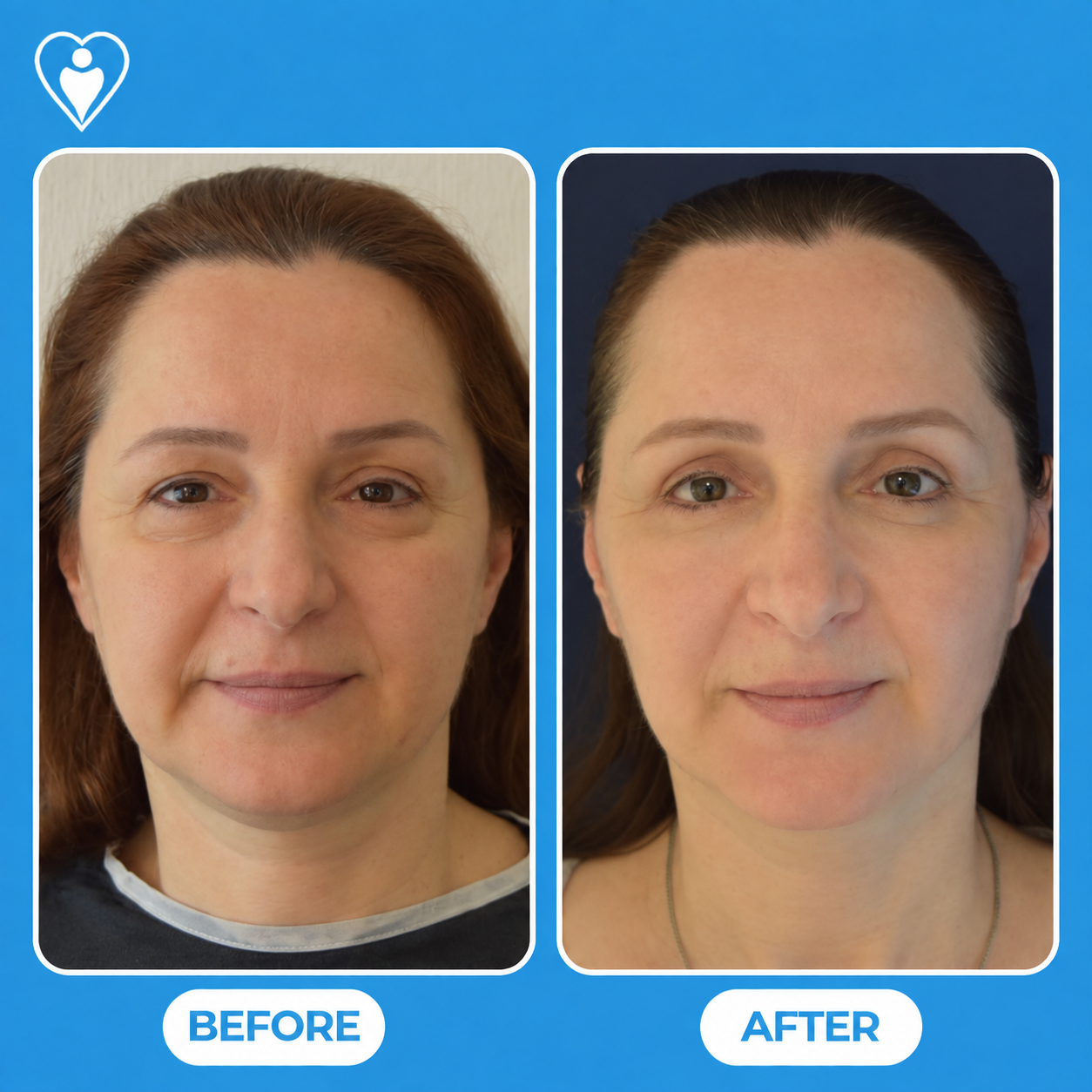 Facial rejuvenation before and after: a woman's front view before, and after facelift surgery, patient of Dr. Gürhan Özcan, Flymedi.