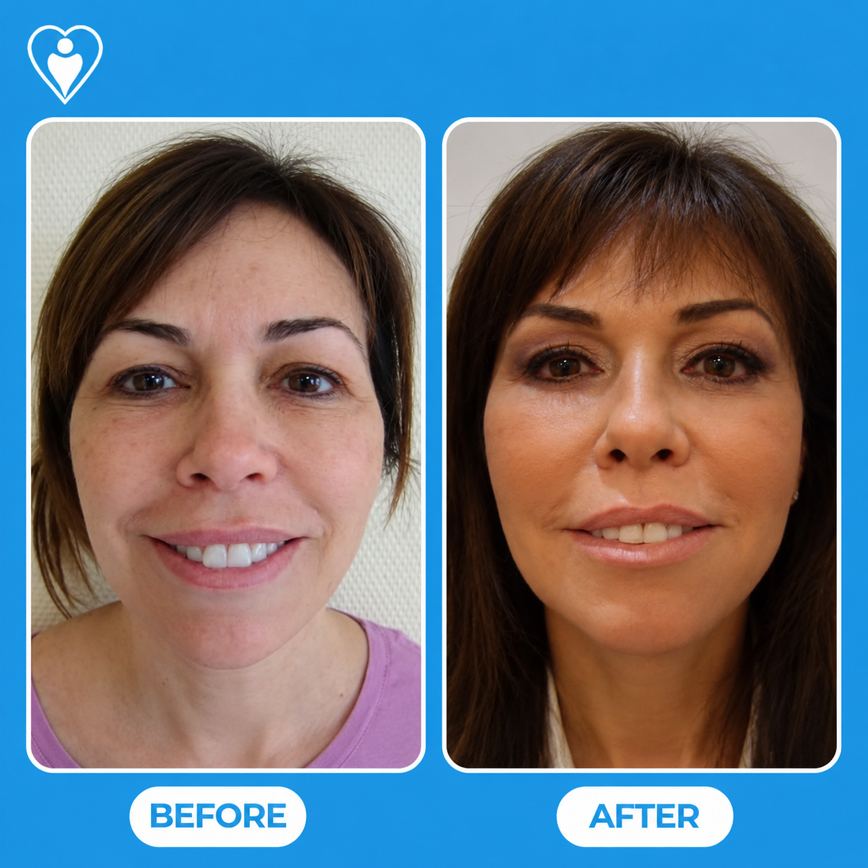 Facelift before and after: a smiling woman's front view before, and after facial rejuvenation surgery, patient of Dr. Gürhan Özcan, Flymedi.