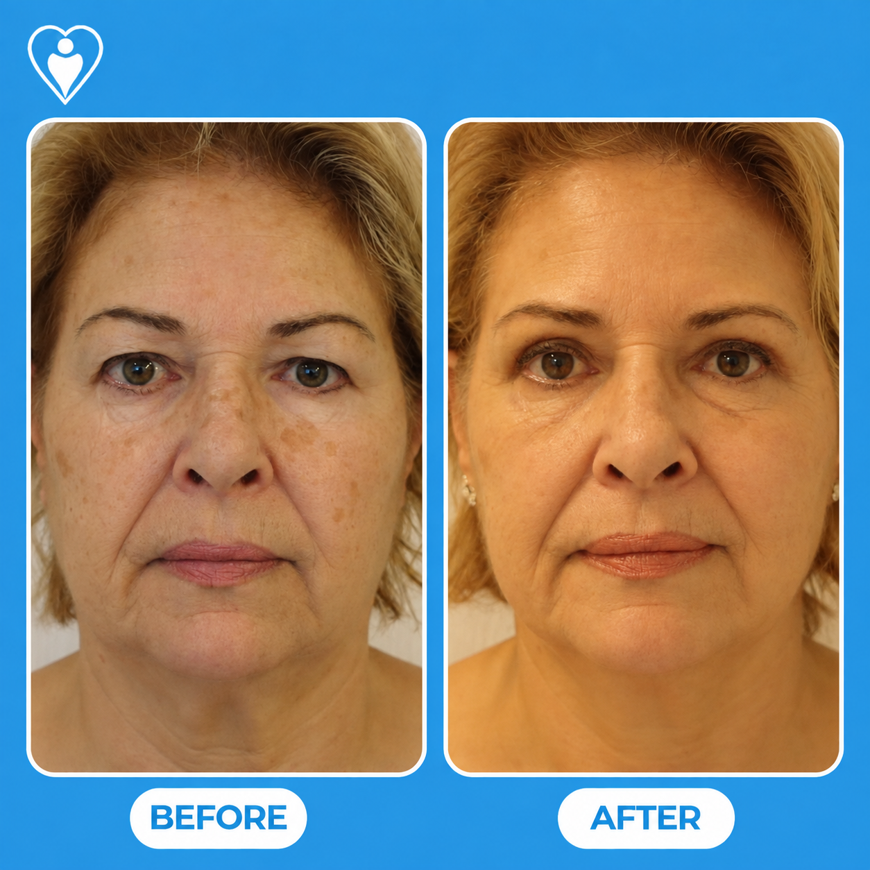 Facelift and eyelid surgery before and after: a woman's front view before, and after facial rejuvenation, patient of Dr. Gürhan Özcan, Flymedi.