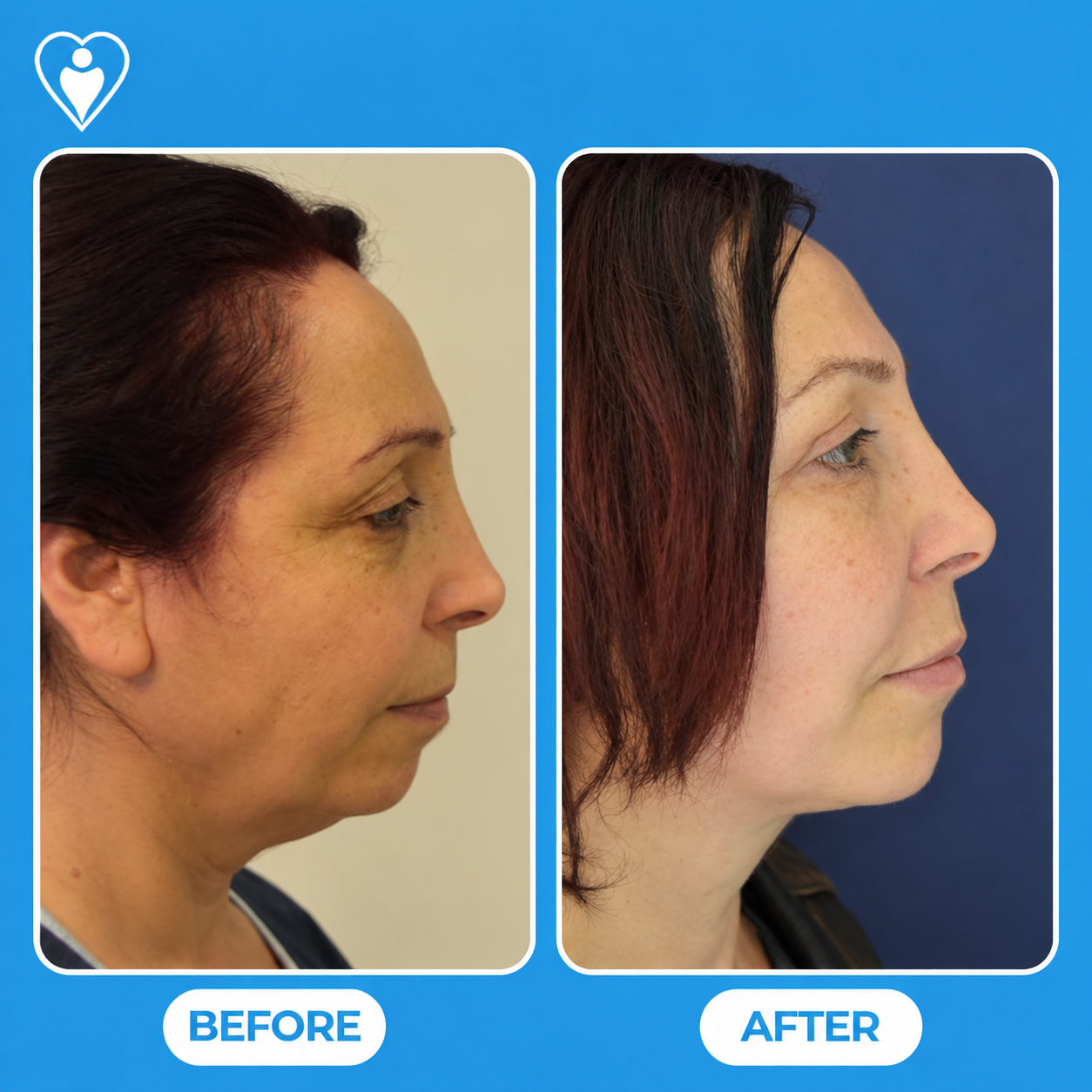 Facelift before and after: a woman's side profile before, and with a redefined jawline after, patient of Dr. Gürhan Özcan, Flymedi.