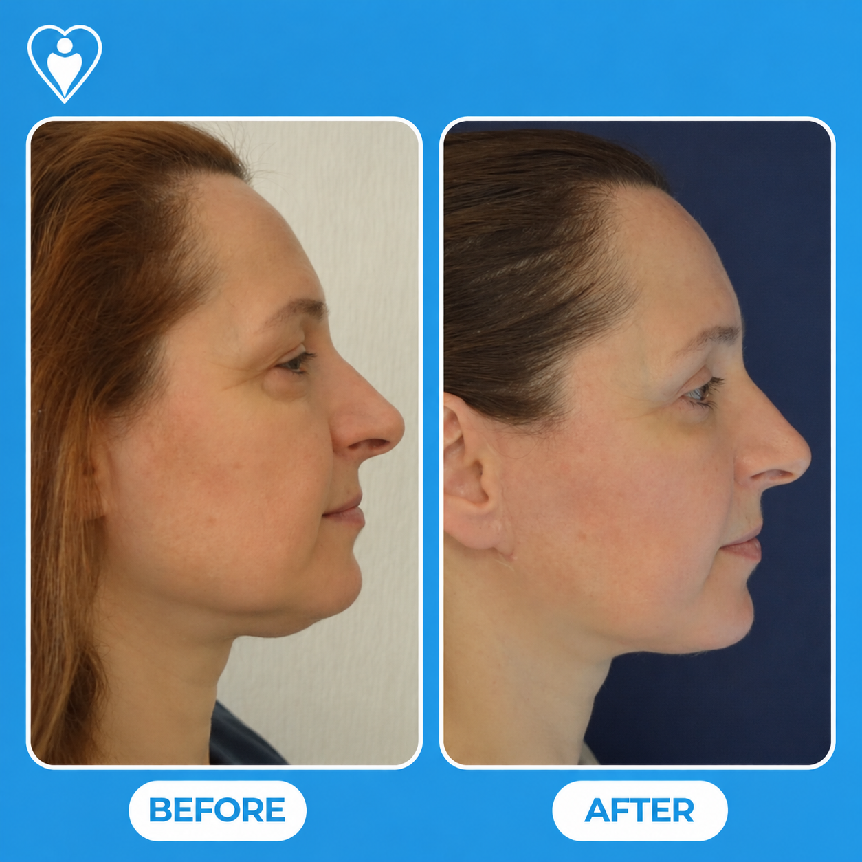 Face and neck lift before and after: a woman's side profile before, and after facelift surgery, patient of Dr. Gürhan Özcan, Flymedi.