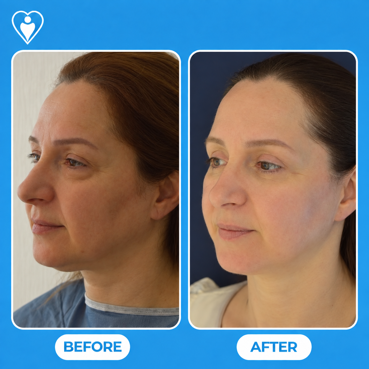 Facial rejuvenation surgery before and after: a woman's side profile before, and with a lifted contour after, patient of Dr. Gürhan Özcan, Flymedi.