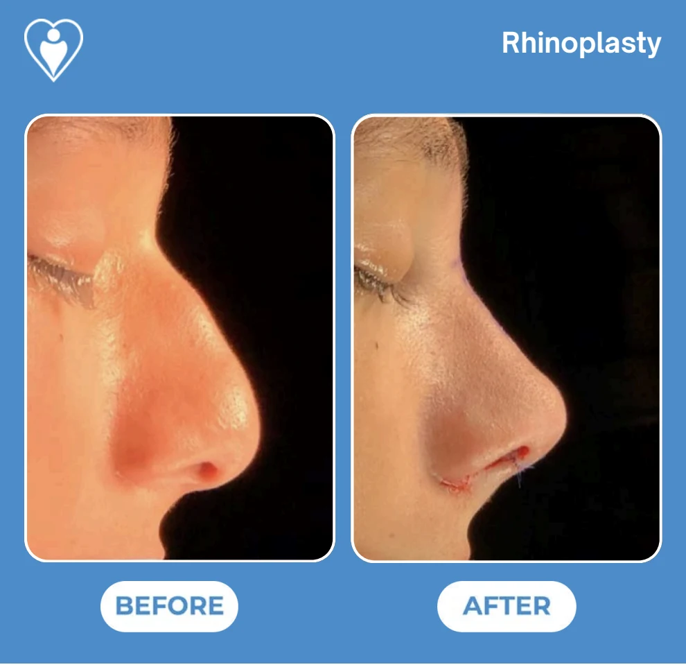 Nose job before and after: a woman's nose in profile before, and shortly after surgery with the stitches still in place, patient of Prof. Güven Güvenç, Flymedi.