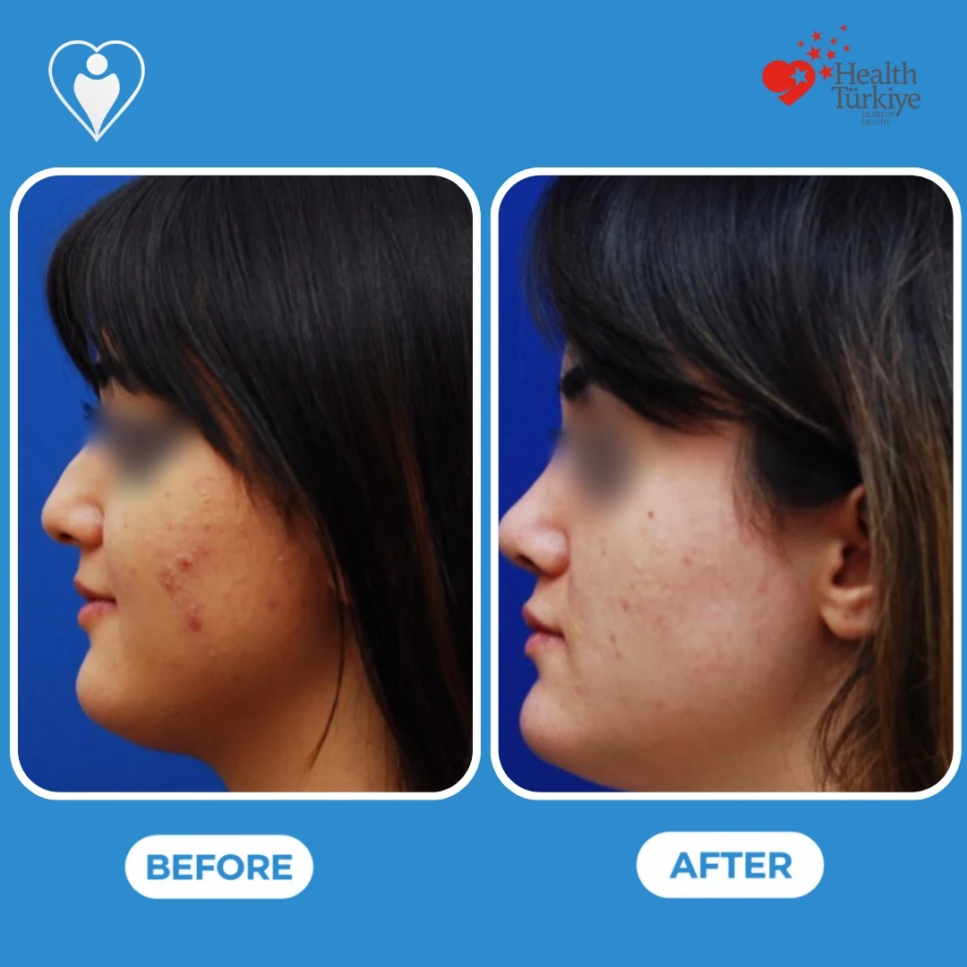 Nose job before and after pictures: a young woman with a fringe in profile before, and with a smaller, more upturned nose after, eyes blurred, patient of Prof. Güven Güvenç, Flymedi.