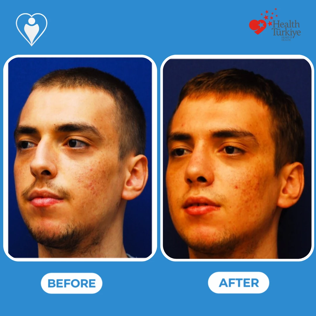 Nose job in Istanbul, before and after: a young man with short hair seen from the side before, and with a straighter, narrower nose after, patient of Prof. Güven Güvenç, Flymedi.