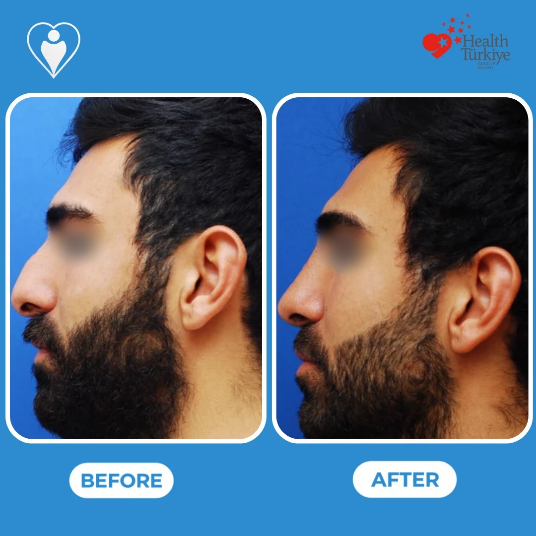 Male rhinoplasty before and after: a bearded man in profile with a hump on the nose before, and with a straight nose bridge after, eyes blurred, patient of Prof. Güven Güvenç, Flymedi.