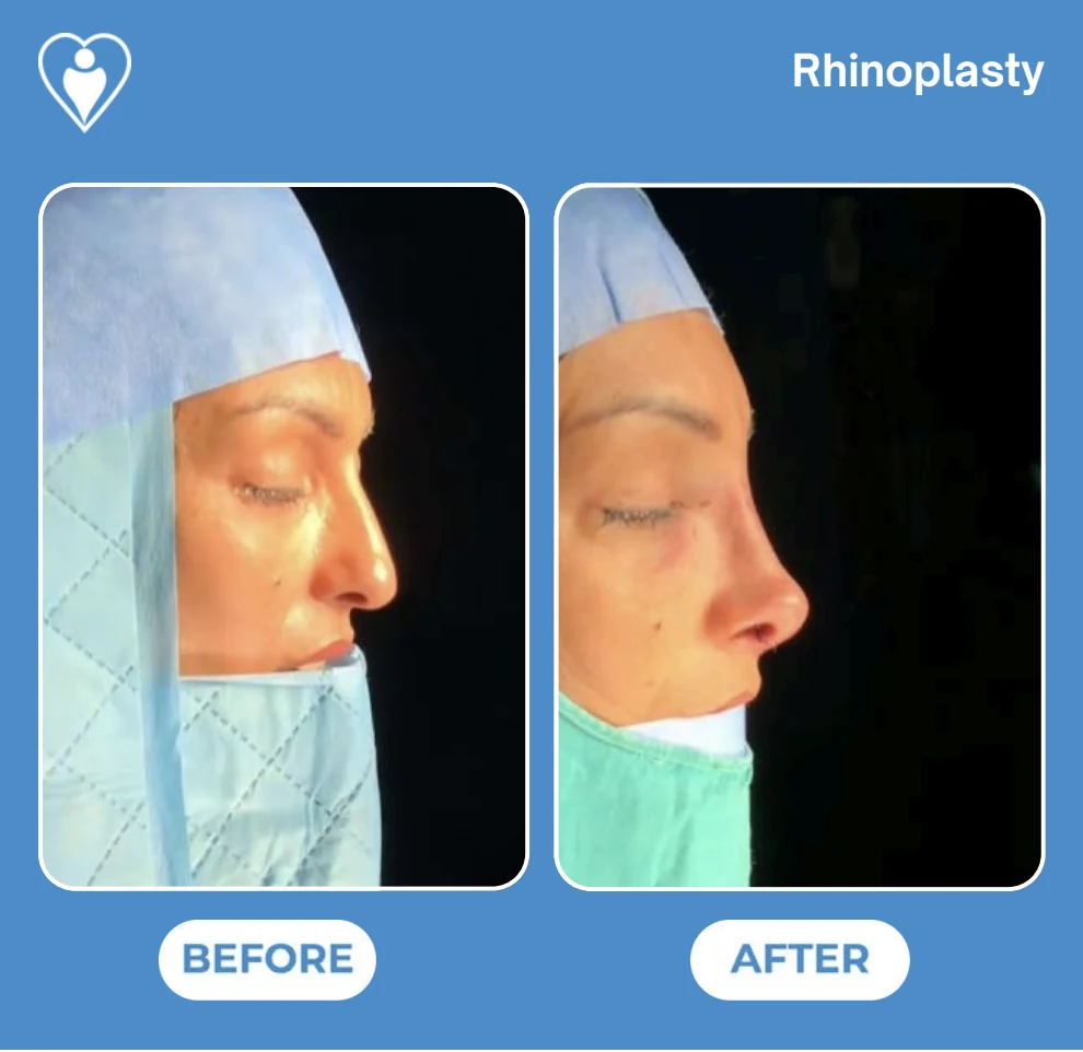 Rhinoplasty before and after: a woman in a surgical cap photographed in profile before and after her nose operation, patient of Prof. Güven Güvenç, Flymedi.