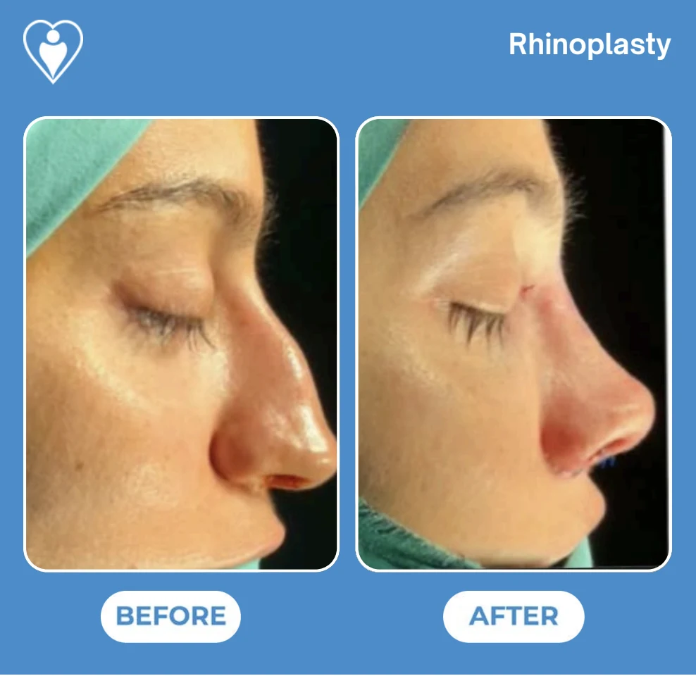 Rhinoplasty in Turkey, before and after: a woman's nose in profile before, and after surgery with the bridge reshaped and stitches still visible, patient of Prof. Güven Güvenç, Flymedi.